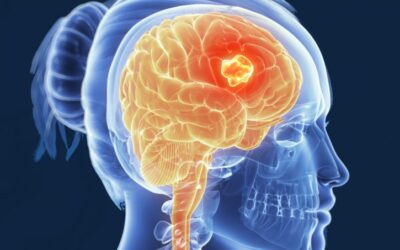 Menos invasiva e onerosa, biópsia líquida em LCR pode aperfeiçoar diagnóstico de tumores no cérebro