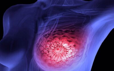 Estudo premiado sobre câncer de mama confere mudanças na indicação de tratamento