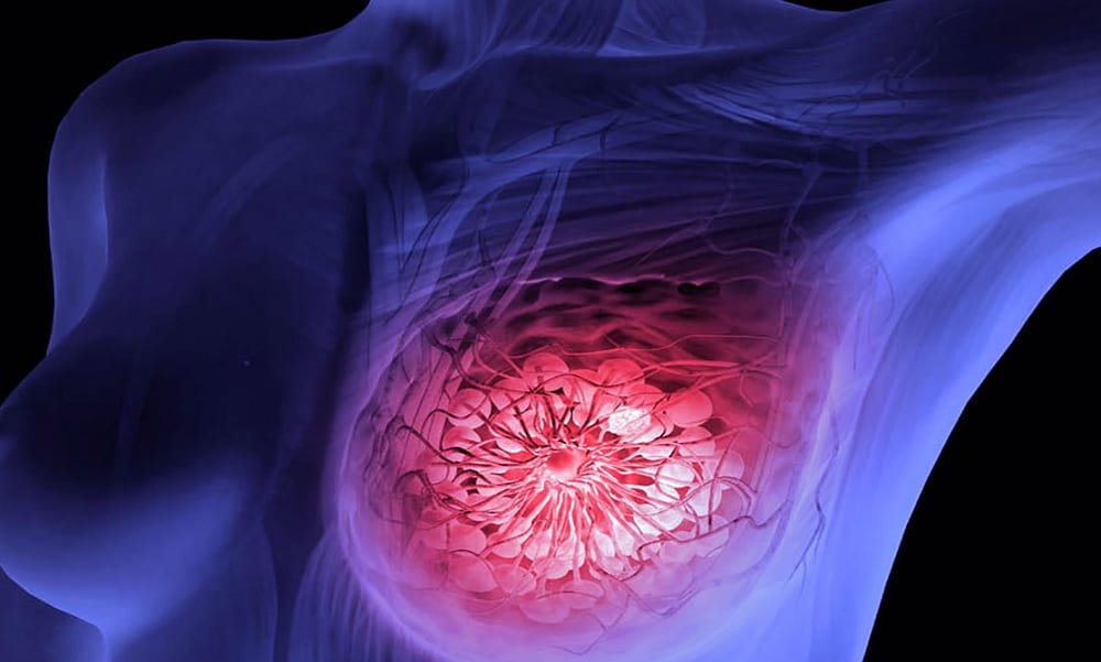 Estudo premiado sobre câncer de mama confere mudanças na indicação de tratamento