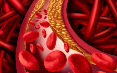 Nova abordagem para a detecção da aterosclerose pode evitar infartos