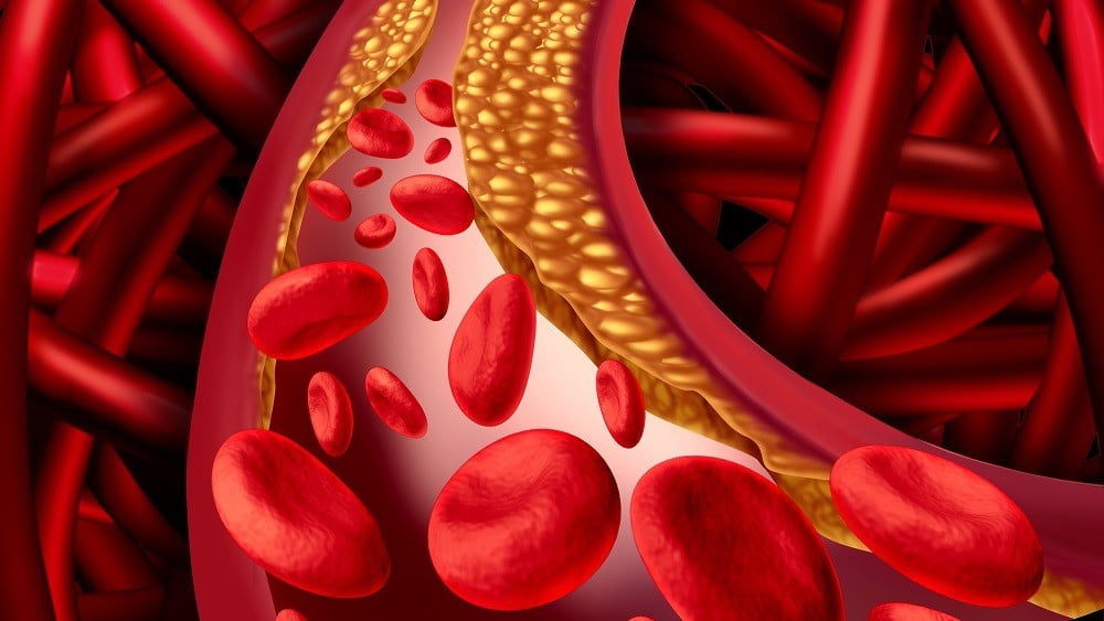 Nova abordagem para a detecção da aterosclerose pode evitar infartos