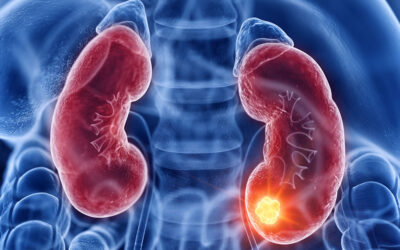 JUNHO VERDE – maioria dos cânceres de rim são assintomáticos e “achados” em exames de rotina