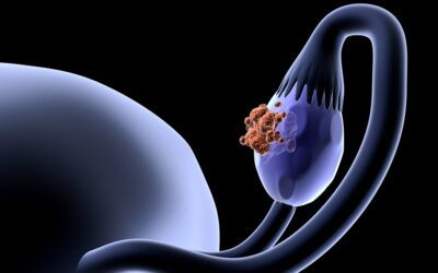 Levantamento de histórico familiar pode atuar no diagnóstico precoce de câncer de ovário