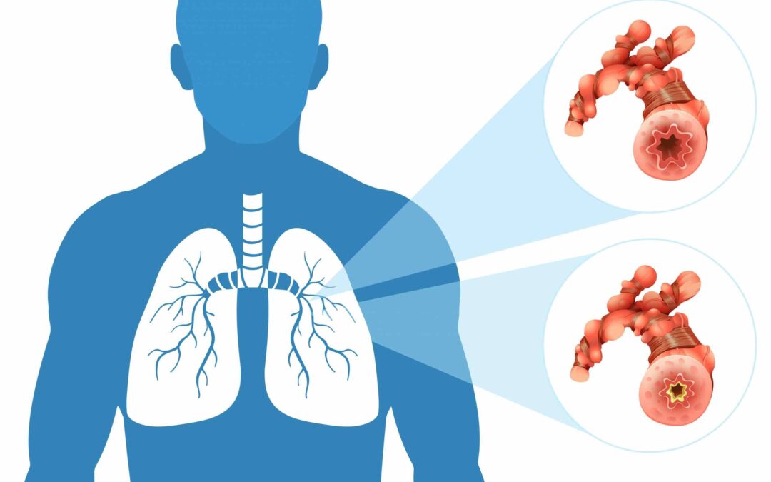 Tuberculose: QIAGEN lança plataforma EAD para expandir exame de referência já disponível no SUS