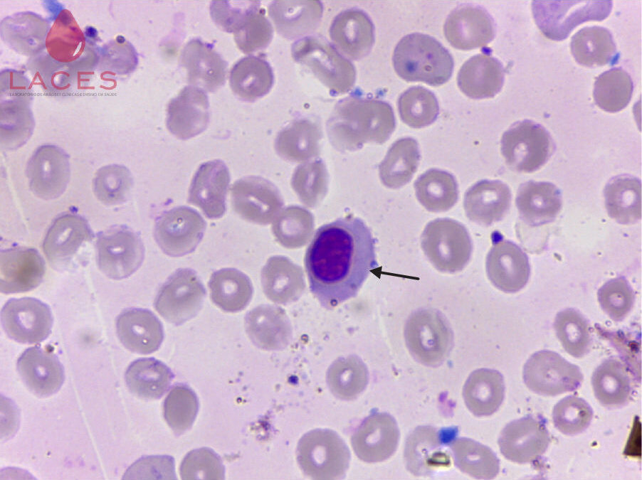 Novo episódio do videocast gratuito da Sysmex aborda o sinal de alerta para eritroblastos circulantes