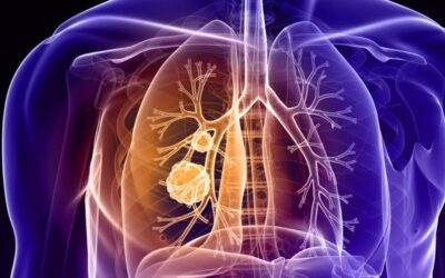 Doença do Beijo Salgado é grave e tem que ser diagnosticada pelo Teste do Pezinho, além de confirmação pelo suor para os recém-nascidos