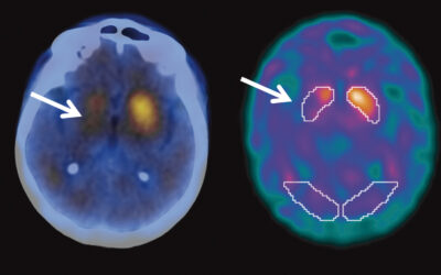Exames de imagem são aliados na detecção de Parkinson e Alzheimer