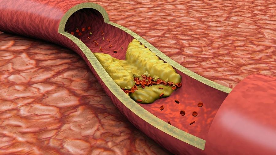 Entendendo o exame de colesterol: quando devo me preocupar?