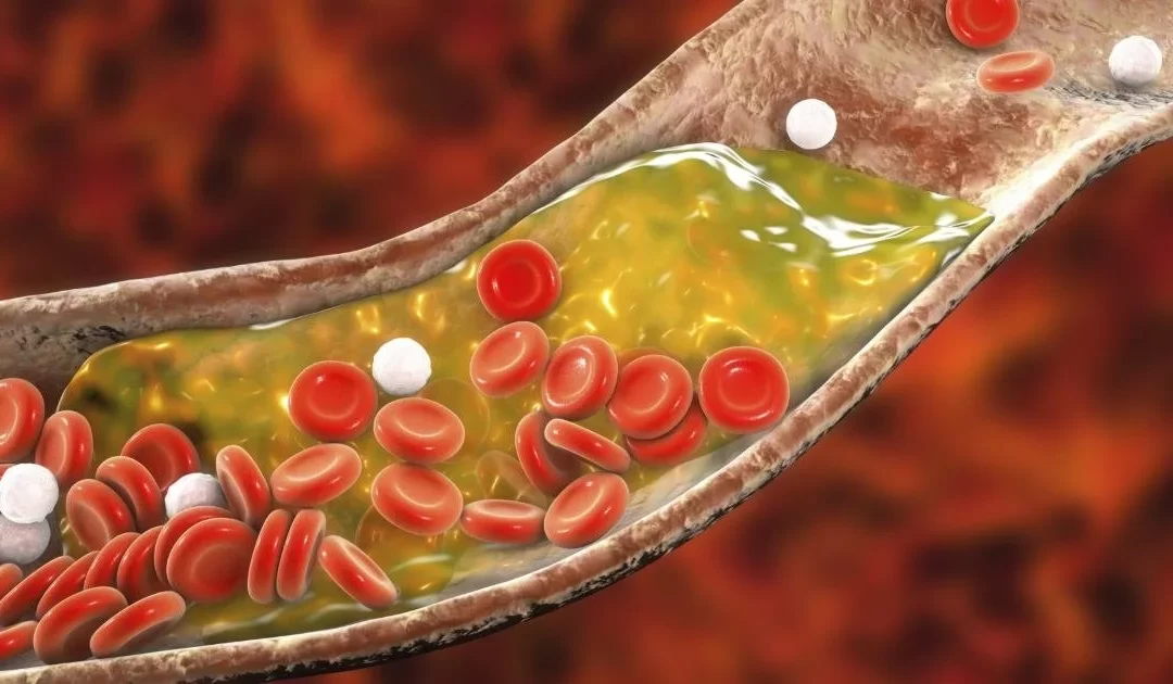 SBC torna mais rígidas as metas para colesterol e cria nova categoria de risco cardiovascular