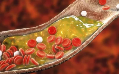 SBC torna mais rígidas as metas para colesterol e cria nova categoria de risco cardiovascular