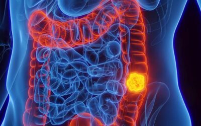 Câncer colorretal: exame lançado por laboratório brasileiro identifica no DNA o risco do tumor