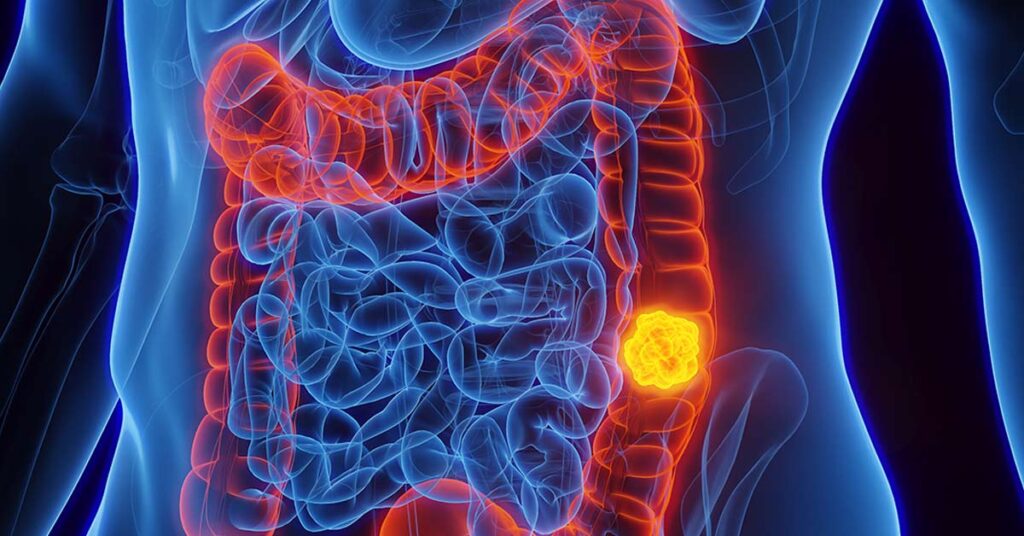 Câncer colorretal: exame lançado por laboratório brasileiro identifica no DNA o risco do tumor