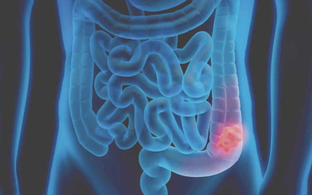 Teste menos invasivo pode ampliar diagnóstico precoce do câncer de intestino